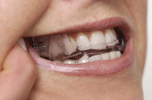Oral Appliance Therapy